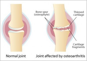 Picture of arthritic knee sourced from www.viciouscycleblog.com
