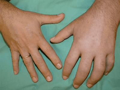 left hand with Complex Regional Pain syndrome