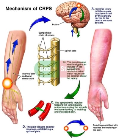 Complex Regional Pain Syndrome, Physiotherapy and rehab