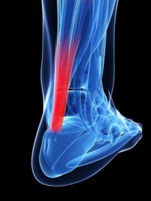 Achilles tendinopathy - a common running injury